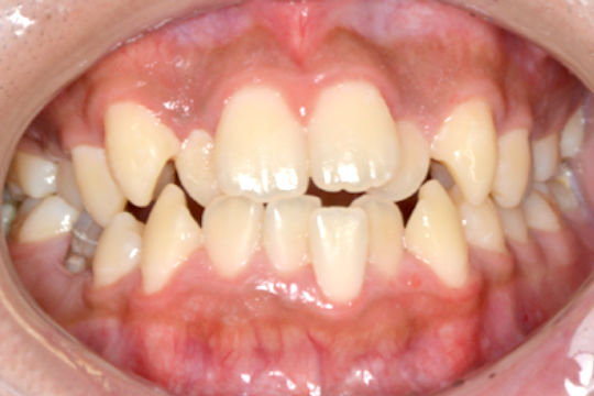 デコボコの歯(叢生)の矯正治療 症例紹介