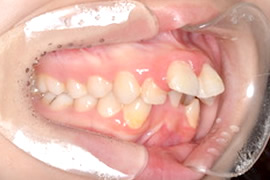 出っ歯 (上顎前突)の矯正治療 症例紹介