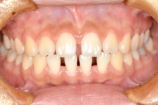すきっ歯 (空隙歯列)の矯正治療 症例紹介